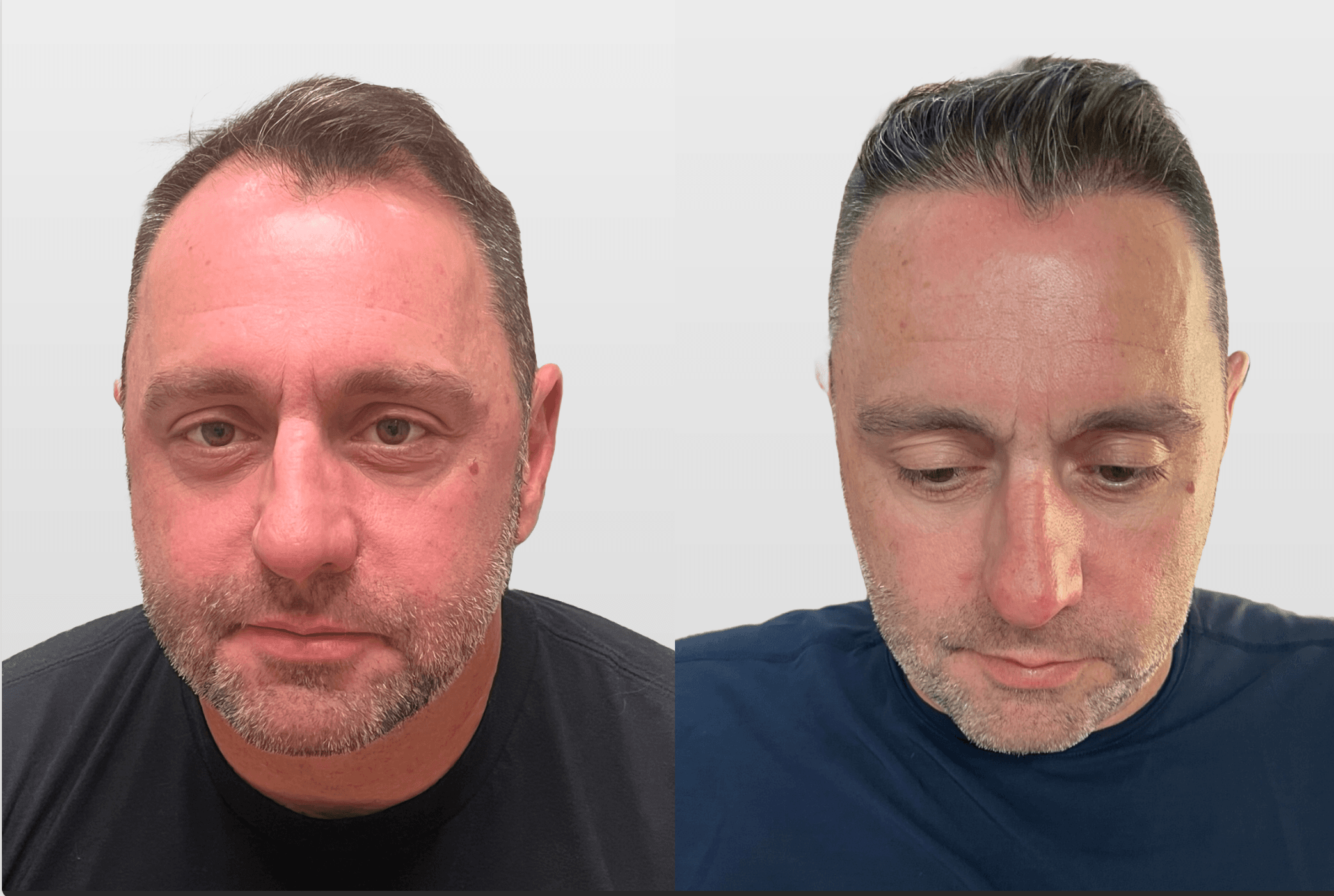 FUE Hair Transplant Before and After Results