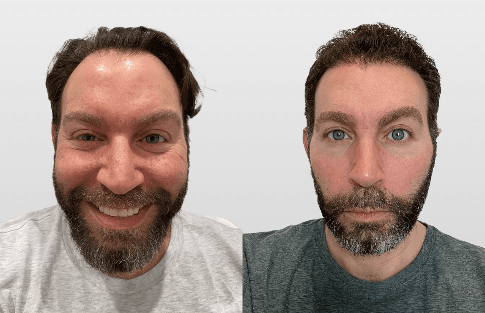 FUE Hair Transplant Before and After Results