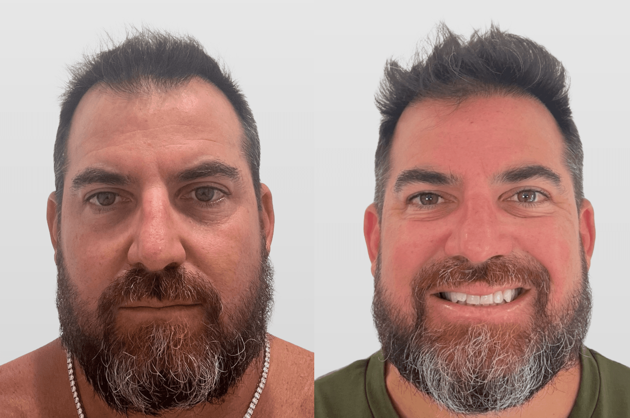 FUE Frontal Hair Transplant Before and After Results