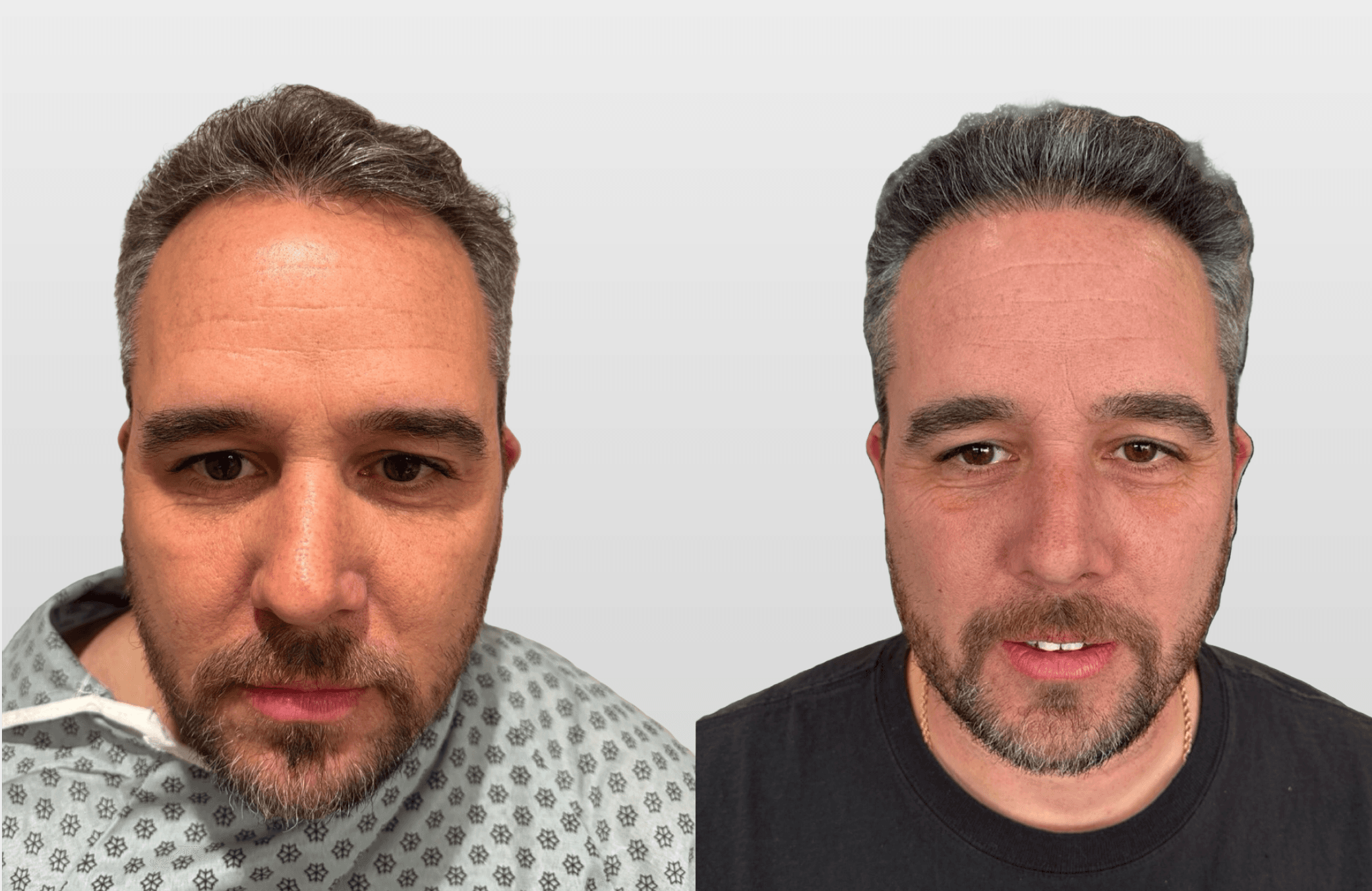 FUE Hair Transplant Before and After Results