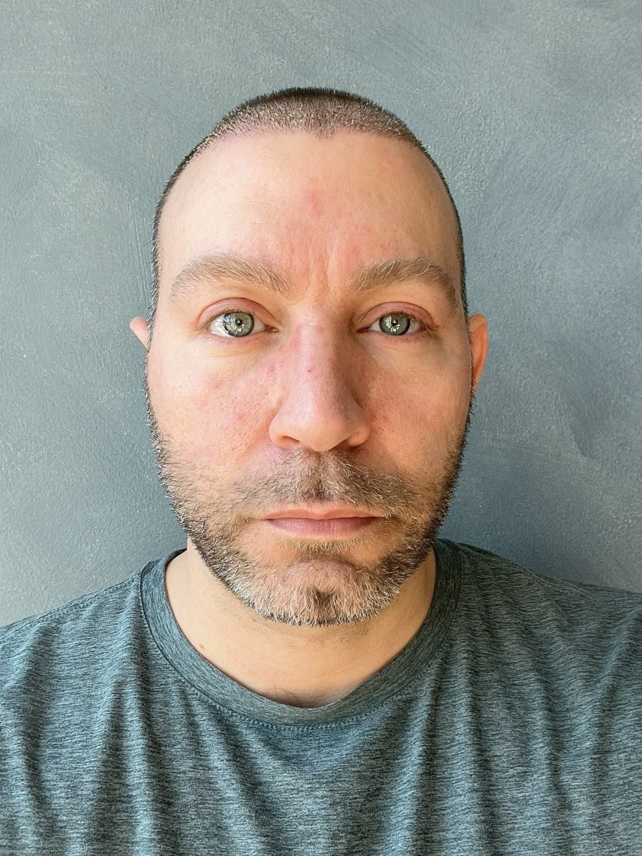5 Days Post-Op