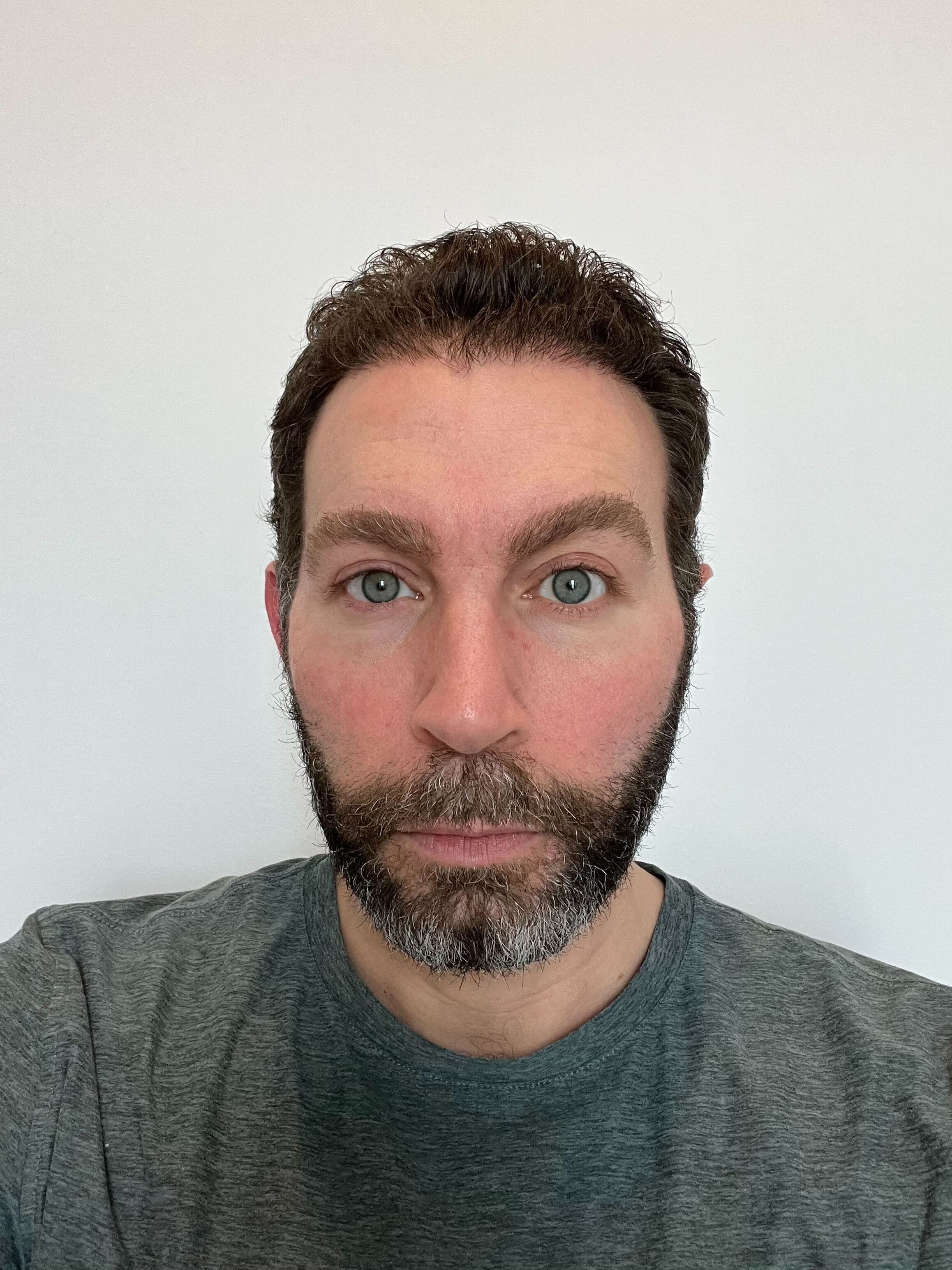 6 Months Post-Op