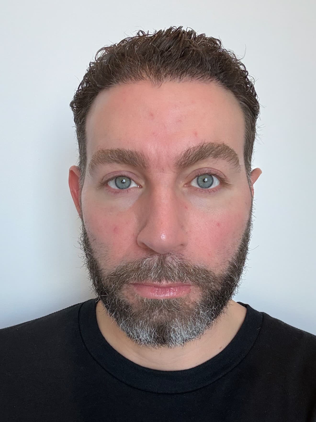 9 Months Post-Op