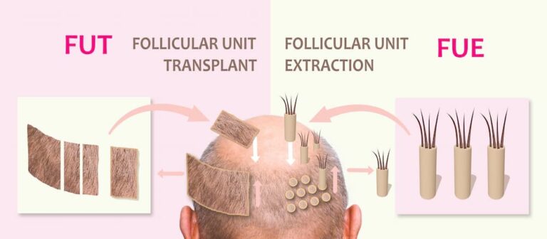 Diagram comparing FUT and FUE hair transplant techniques, showing strip harvesting for FUT and individual follicle extraction for FUE.