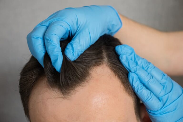 Close-up of a specialist examining a man’s hairline before an FUE hair transplant, assessing donor and thinning areas for precise treatment planning.