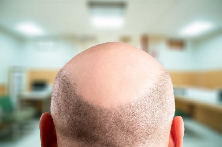 Back of a bald man's head with visible hair loss pattern—illustrating a common donor area before FUE hair transplant treatment.