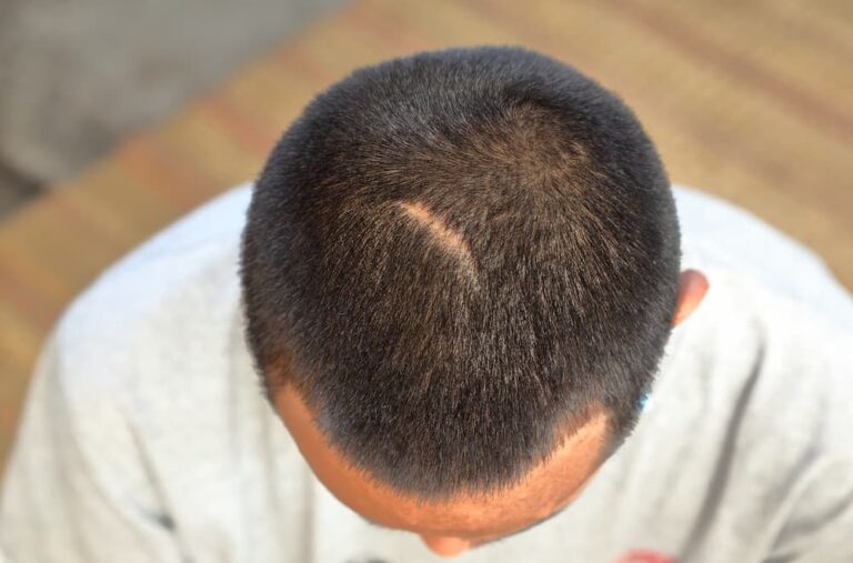 Top-down view of a man's scalp with short dark hair, showing a thin, linear surgical scar often associated with the Follicular Unit Transplant (FUT) "strip" harvesting method.