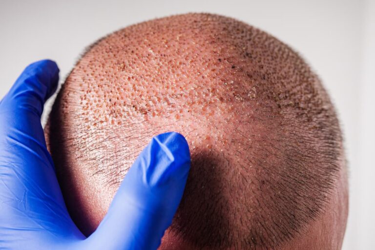 Close-up of a patient's scalp during FUE hair transplant recovery showing scabs and healing grafts being examined by a specialist.