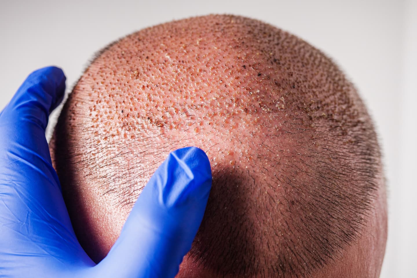Close-up of a patient's scalp during FUE hair transplant recovery showing scabs and healing grafts being examined by a specialist.