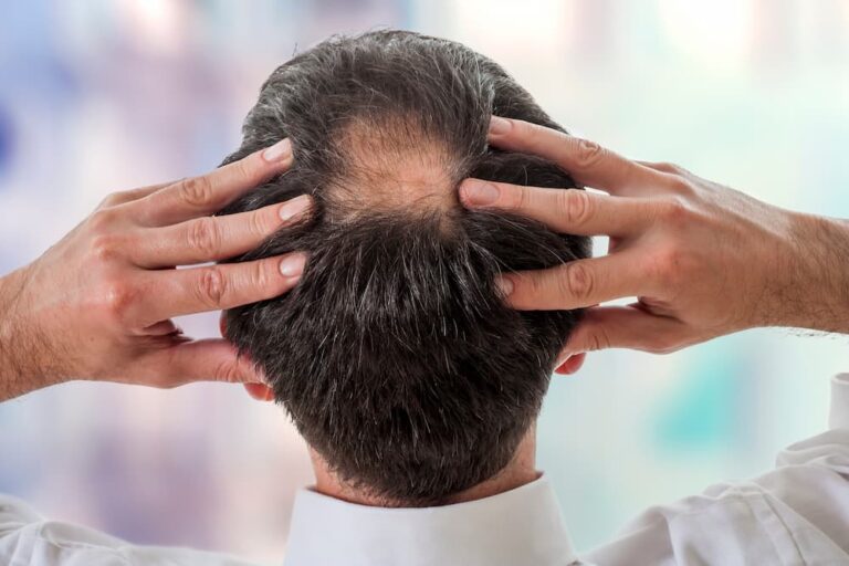 Man with thinning hair at crown showing early-stage androgenetic alopecia, holding head with both hands, used to illustrate PRP vs PRF hair loss treatment comparison
